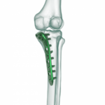 4.5mm Proksimal Tibia Medial Anatomik Plak
