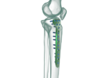 Proksimal Tibia Medial (3.5) Anatomik Plak
