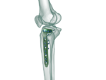 Proksimal Tibia Lateral (3.5) Anatomik Plak