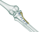 Proksimal Tibia Posteromedial Plak - Görsel 2