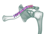 Superior Distal Klavikula Anatomik Plak - Görsel 2