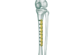 4.5mm Tibia Düz Plak