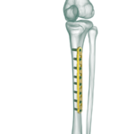 4.5mm Tibia Düz Plak