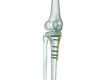 YTO - Proksimal Tibia Yüksek Osteotomi Anatomik Plak - Görsel 2