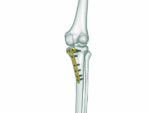 YTO - Proksimal Tibia Yüksek Osteotomi Anatomik Plak