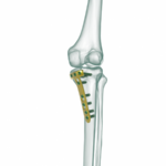 YTO - Proksimal Tibia Yüksek Osteotomi Anatomik Plak