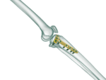 YTO - Proksimal Tibia Yüksek Osteotomi Anatomik Plak - Görsel 3